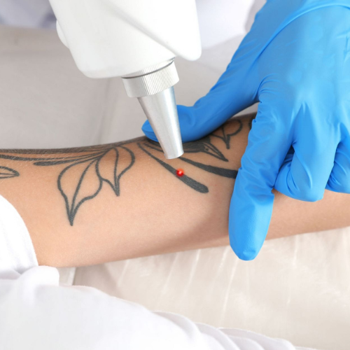 Tattoo removal